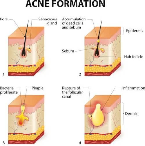 Các yếu tố chính gây ra mụn Các yếu tố chính gây ra mụn