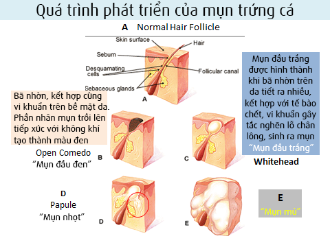 Quá trình phát triển của mụn trứng cá Quá trình phát triển của mụn trứng cá