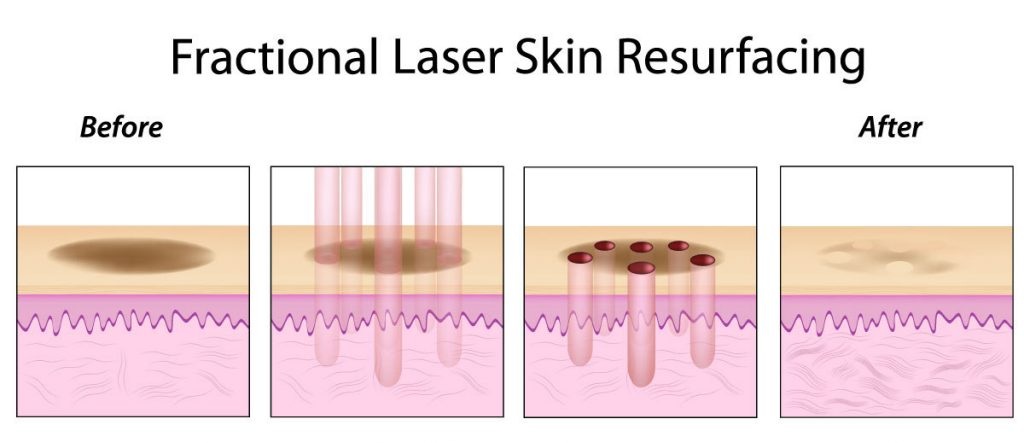 Công nghệ điều trị thâm nách - sáng da vùng cánh tay bằng Laser CO2 Fractional